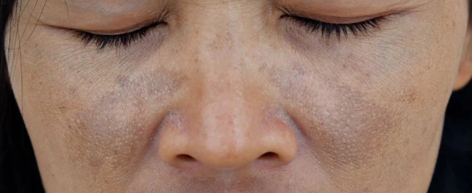 Complexities of Pigmentation