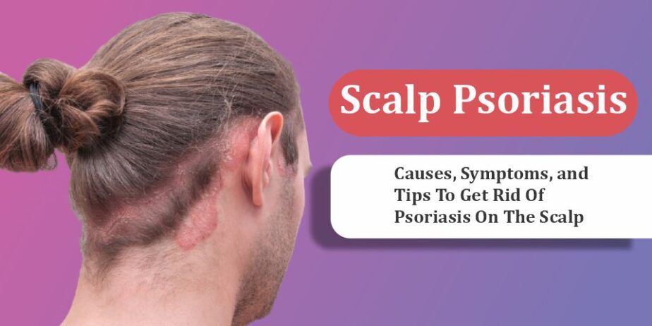 Scalp-Psoriasis