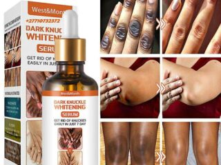 Dark Knuckle Whitening Serum Hand Elbow Knee Brightening Serum In Benguela City in Angola, Nigel And Saldanha Town Call +2771 073 2372 Get Rid Of Scars And Stretch Marks In Johannesburg South Africa And Kherson City in Ukraine